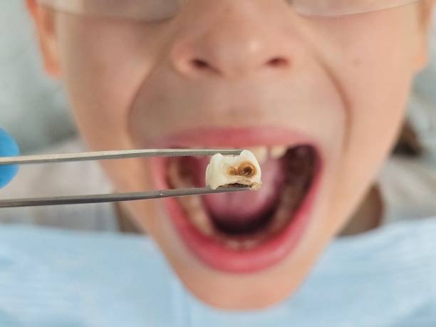 Best Emergency Dental Care for Broken or Chipped Teeth in Grove Hill, AL
