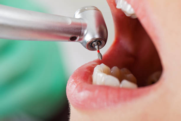 Best Emergency Tooth Extraction in Grove Hill, AL
